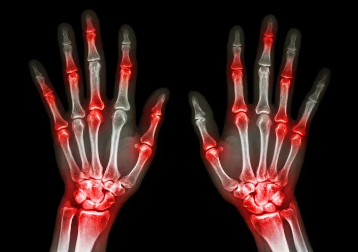 Natural Arthritis Pain Relief